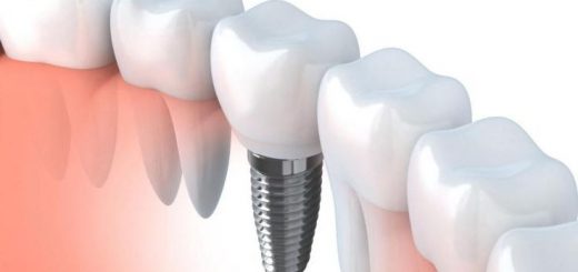Преимущество установки зубных имплантов
