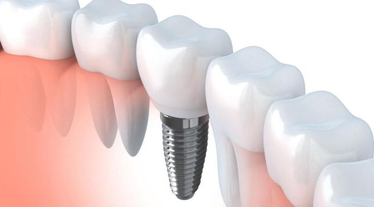 Преимущество установки зубных имплантов