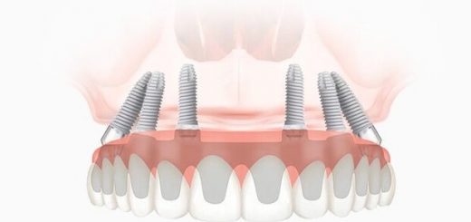 All on 6 имплантация и протезирование зубов