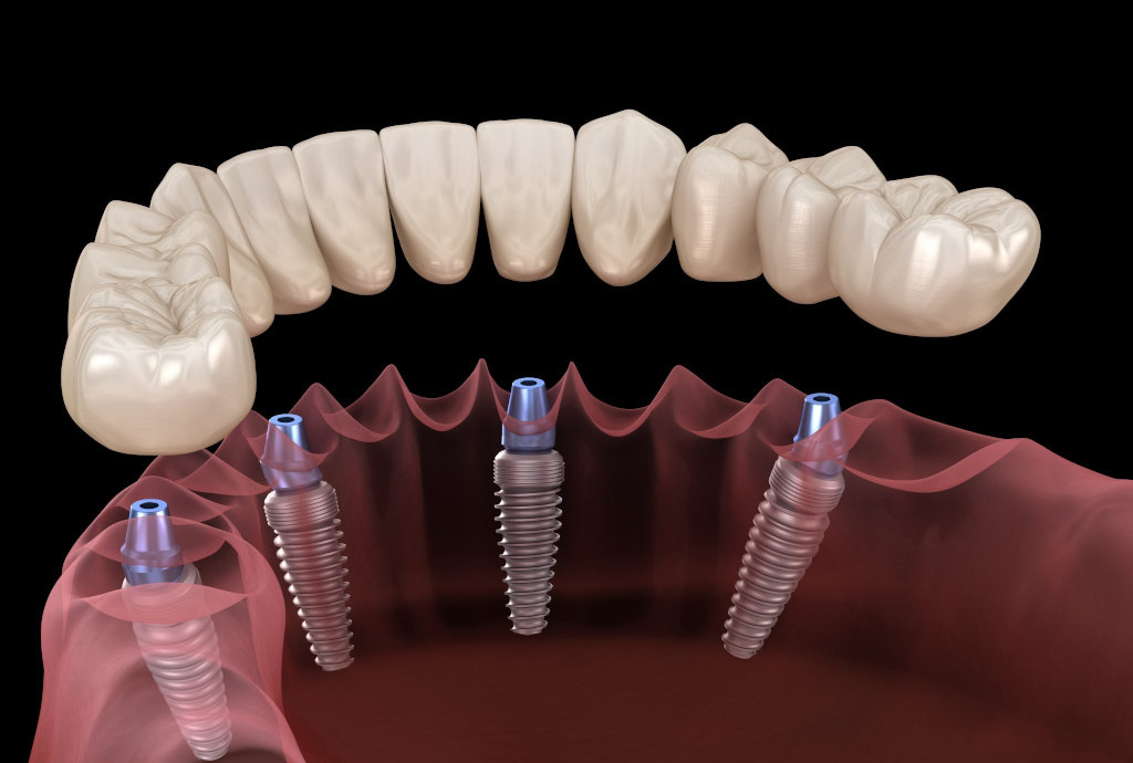 протезирование на 4 имплантах