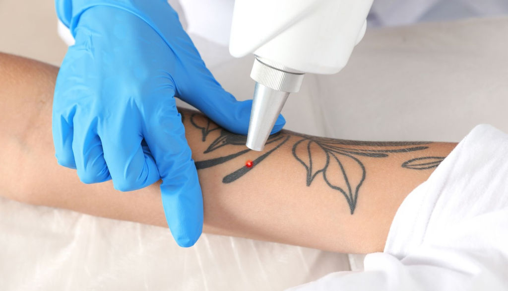 Удаление татуировки лазером