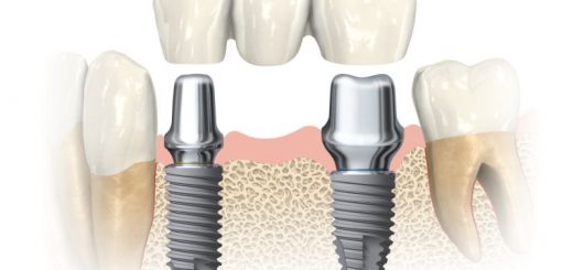 Имплантация зубов