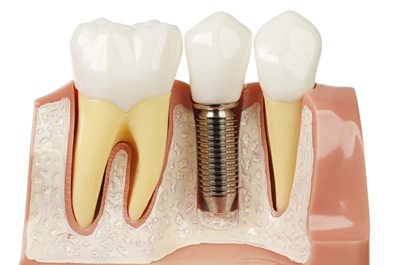 Стоматологическая имплантация зубов